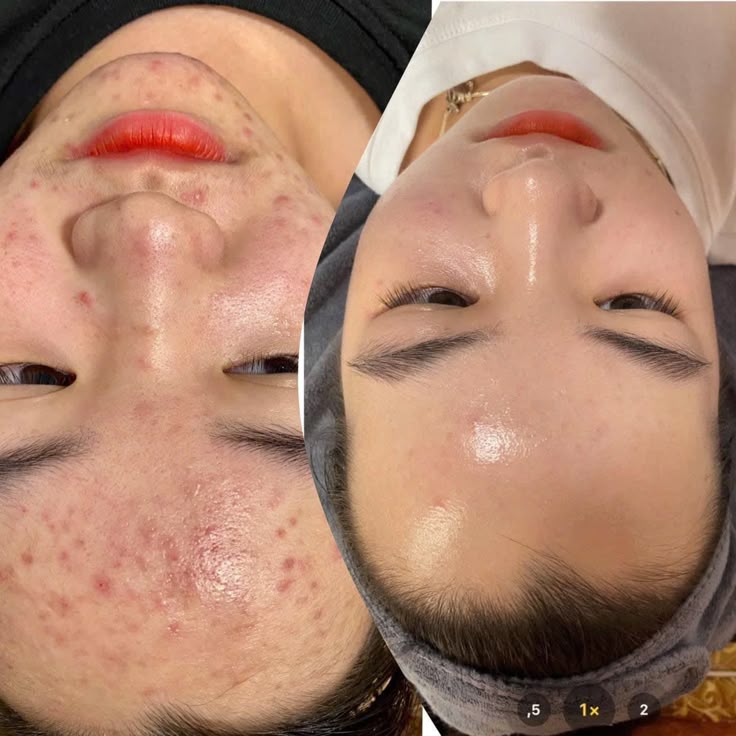 Trị Mụn